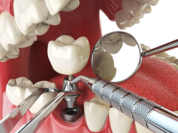 Best Emergency Dentist for Lost Fillings or Crowns in Pullman, WA